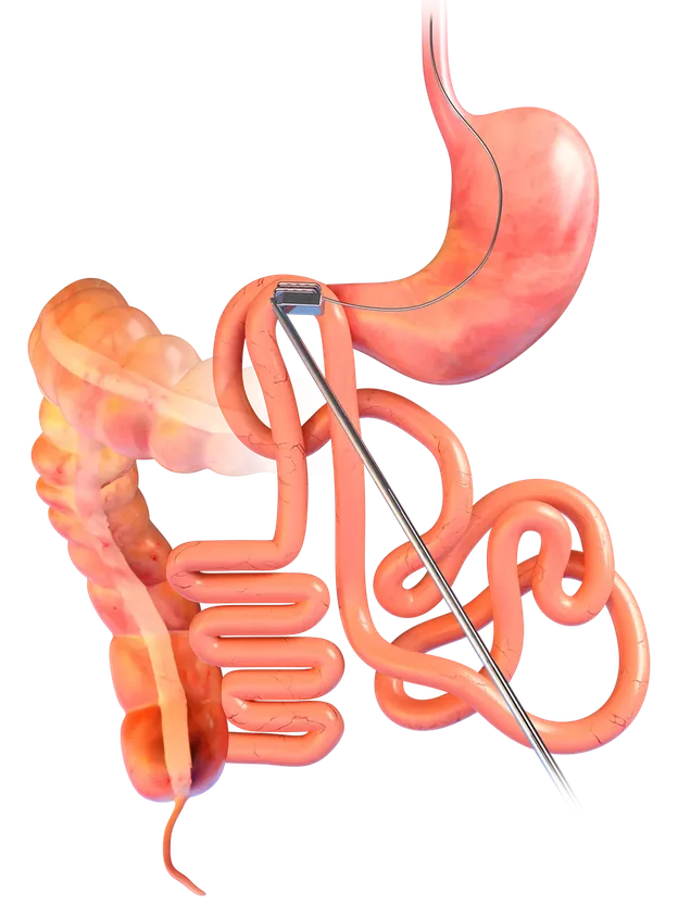 The two magnets meeting between two sections of the gut