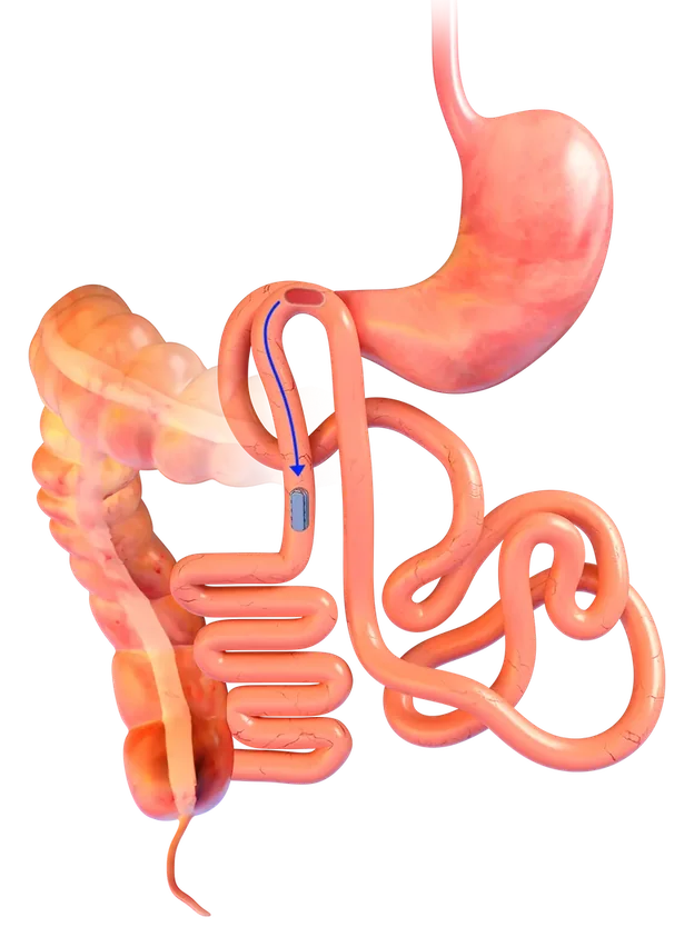 The magnets, still joined, moving on through the intestine